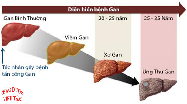 điều trị viêm gan