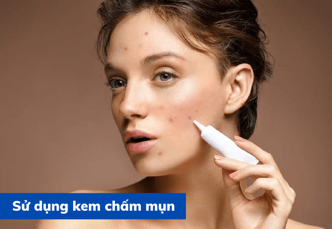 Thoa kem mụn lên nốt mụn